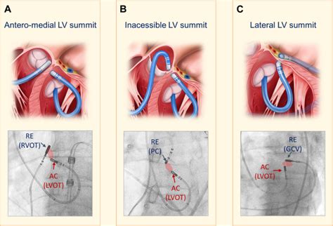 lv summit pvc ablation|lvot ablation.